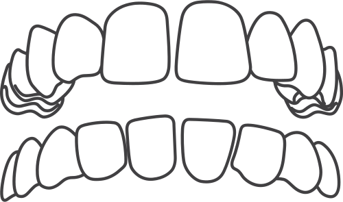 Diastema